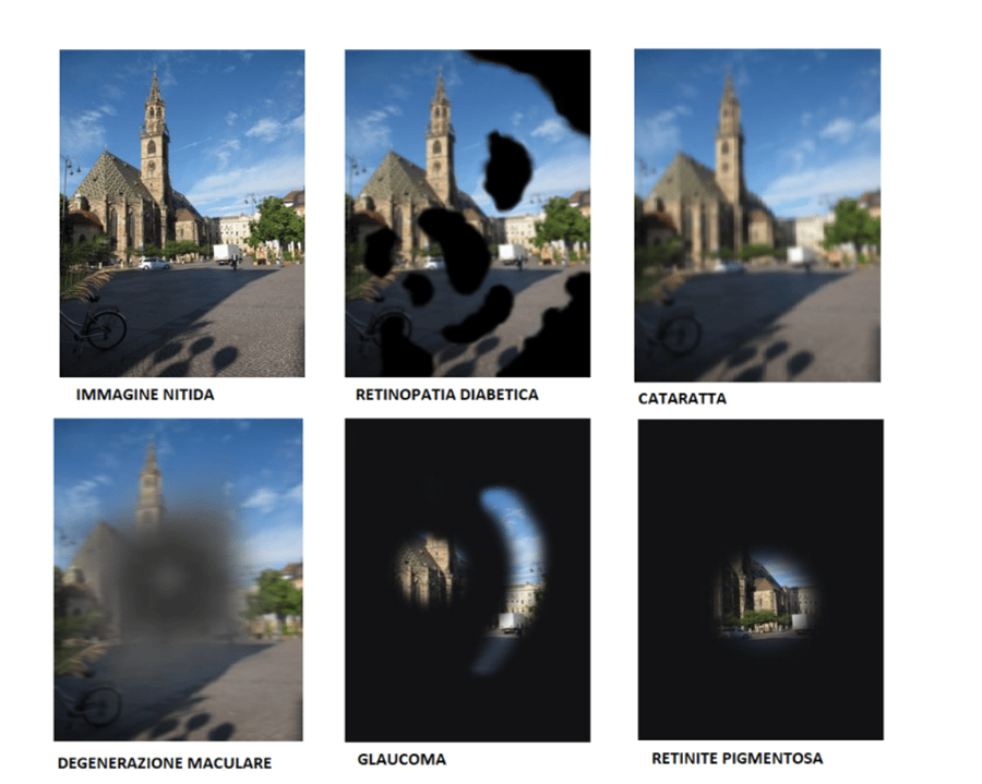 Simulazione dell'ipovisione con sei immagini della stessa scena: una chiesa con cielo azzurro su una piazza. L'immagine iniziale è nitida, mentre le altre mostrano diverse condizioni visive: retinopatia diabetica con macchie scure, cataratta con sfocatura generale, degenerazione maculare con un’area centrale sfocata, glaucoma con visione periferica ridotta e retinite pigmentosa con un piccolo campo visivo centrale.